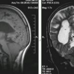 Arnold-Chiari malformation (II) on MRI