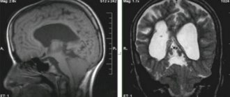 Arnold-Chiari malformation (II) on MRI