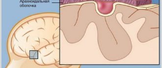 Arachnoid changes of liquorocystic nature