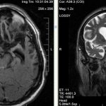 Atrophy of the frontal and temporal lobes on MRI scans