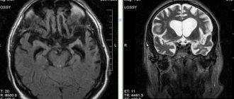 Atrophy of the frontal and temporal lobes on MRI scans