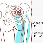 Боль при воспалении седалищного нерва