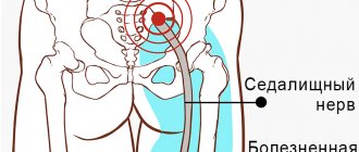 Pain due to inflammation of the sciatic nerve