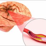 Cerebral ischemia in newborns