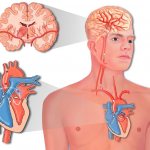 What is the difference between a heart attack and a stroke?