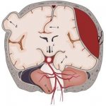 дислокация головного мозга