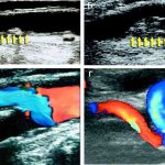 Duplex scanning of the internal carotid artery. A formed small atherosclerotic plaque is visible, the lumen of the vessel is slightly narrowed (A); later stage of atherosclerosis - the lumen of the vessel of the internal carotid artery is partially blocked by a large plaque (B); occlusion - complete closure of the lumen of a vessel with a plaque (B); artery tortuosity (D) (Image: Science and Life) 