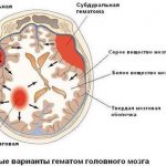 Гематомы головного мозга