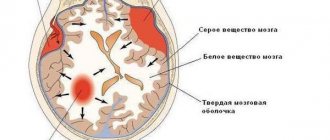 Brain hematomas