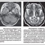 Heart attack on MRI