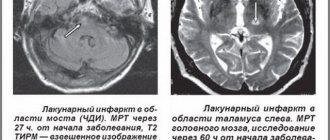 Heart attack on MRI