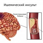 Ischemic stroke