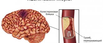 Ischemic stroke