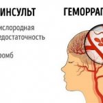 Ischemic stroke