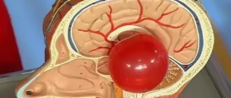 brain cyst