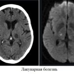 Head cyst in a child