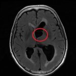 Киста на МРТ головного мозга
