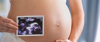 Киста сосудистого сплетения может быть определена на этапе внутриутробного развития, к моменту родов она обычно исчезает