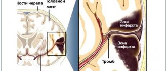 кома-после-инсульта-мозг.jpg