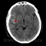 CT scan of the brain. Blood in the subarachnoid cerebrospinal fluid spaces on the right. (photo by V.N. Vishnyakov) 