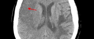 CT scan of the brain. Extensive ischemic stroke in the temporal and parietal lobes on the right 