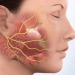 Massage for neuritis of the facial nerve