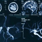 MRI of the brain and blood vessels