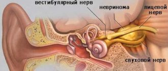 Невринома слухового нерва (шваннома)