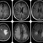 Foci of damage to the central nervous system in multiple sclerosis