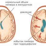 Особенности и механизм развития гидроцефалии