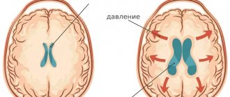 Features and mechanism of development of hydrocephalus