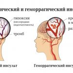 Difference between ischemic and hemorrhagic stroke