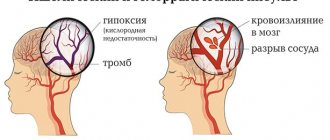 Difference between ischemic and hemorrhagic stroke