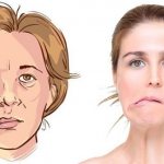 Bell&#39;s palsy