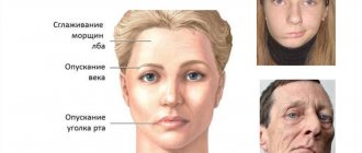 Facial nerve paralysis