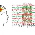 Partial epilepsy - Summer