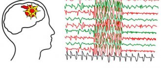 Partial epilepsy - Summer