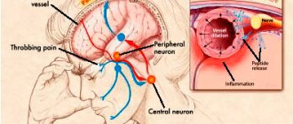 Pathogenesis of migraine