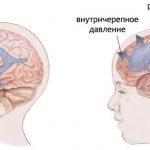 При повышении внутричерепного давления скапливающаяся в желудочках мозга жидкость приводит к появлению тупой распирающей боли