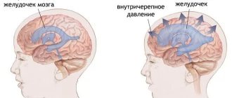 When intracranial pressure increases, fluid accumulating in the ventricles of the brain leads to dull, arching pain.