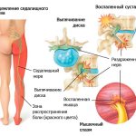 When the sciatic nerve is pinched, the pain spreads to the entire leg