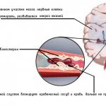 Stroke is caused by cholesterol in the blood vessels of the brain.