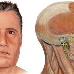 causes of facial paralysis