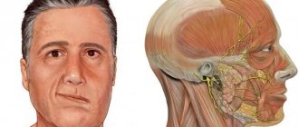 causes of facial paralysis