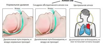 Принцип проявления СОАС и центрального апноэ сна