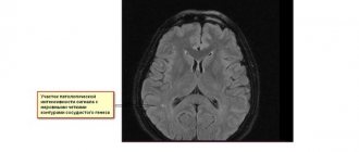 Signs of brain depression