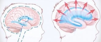 Расширение ликворных пространств головного мозга