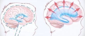 Expansion of the cerebrospinal fluid spaces of the brain