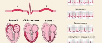 registration of tachyarrhythmia attack