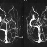 Diagram of cerebral circulation on MRI